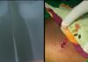 తొడలో గుచ్చుకున్న రాడుముక్కలు తొలగింపు